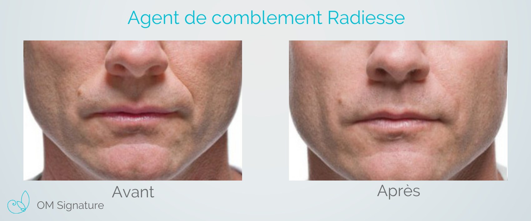 Injection De Radiesse Clinique M dico Esth tique St Lambert Injection De Radiesse Clinique M dico Esth tique St Lambert